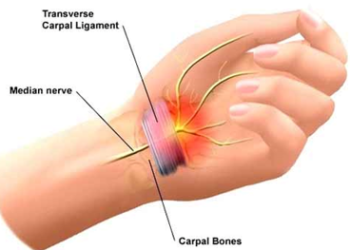 Wist carpal tunnel syndrome(손목터널 증후군)TEST방법과 간단한 스트레칭을 배워봅시다.